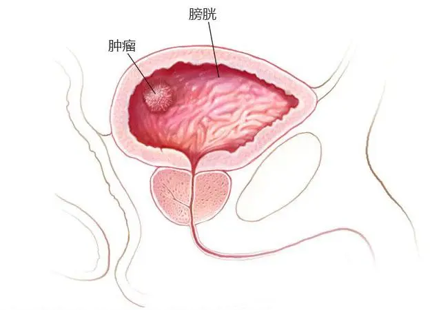 杭州御和堂中医提醒：膀胱癌能活多久