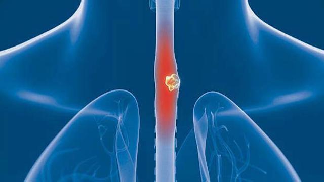 杭州肿瘤中医：区分食道癌与咽炎 食道癌有这些早期症状