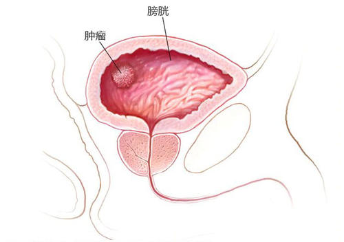 ：膀胱癌早期转移症状